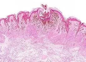 Cutaneous Squamous Cell Carcinoma