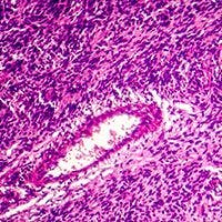 Camsirubicin in Sarcoma: © Dr_Microbe - stock.adobe.com