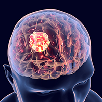 FG001 Meets Detection End Point in High-Grade Glioma | Image Credit: © Dr Microbe - stock.adobe.com.