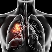 CLN-081 continued to produce encouraging, durable responses with favorable safety and tolerability in patients with non–small cell lung cancer whose tumors harbor EGFR exon 20 insertion mutations and who have progressed on or after prior therapy.