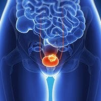 IMRT Linked With Low Rates of Pelvic Recurrence in Bladder Cancer