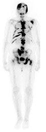 bone scan showing metastases