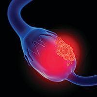 Maintenance Olaparib/Bevacizumab Provides Substantial PFS, PFS2 Benefit in HRD+ Ovarian Cancer, Irrespective of Disease Stage