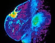 Two Studies Suggest Pattern of Misuse for Breast MRIs