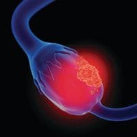 Olaparib Plus Bevacizumab Maintenance Therapy Provides OS Benefit in Advanced HRD-Positive Ovarian Cancer 