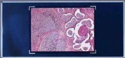 Prostate Cancer under a microscope