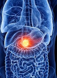 Glecirasib in KRAS G12C–Mutated 

Pancreatic Cancer | Image Credit: 

© SciePro - stock.adobe.com