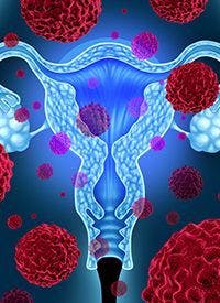 Durvalumab Combo in Advanced Endometrial Cancer | Image Credit: © freshidea - stock.adobe.com