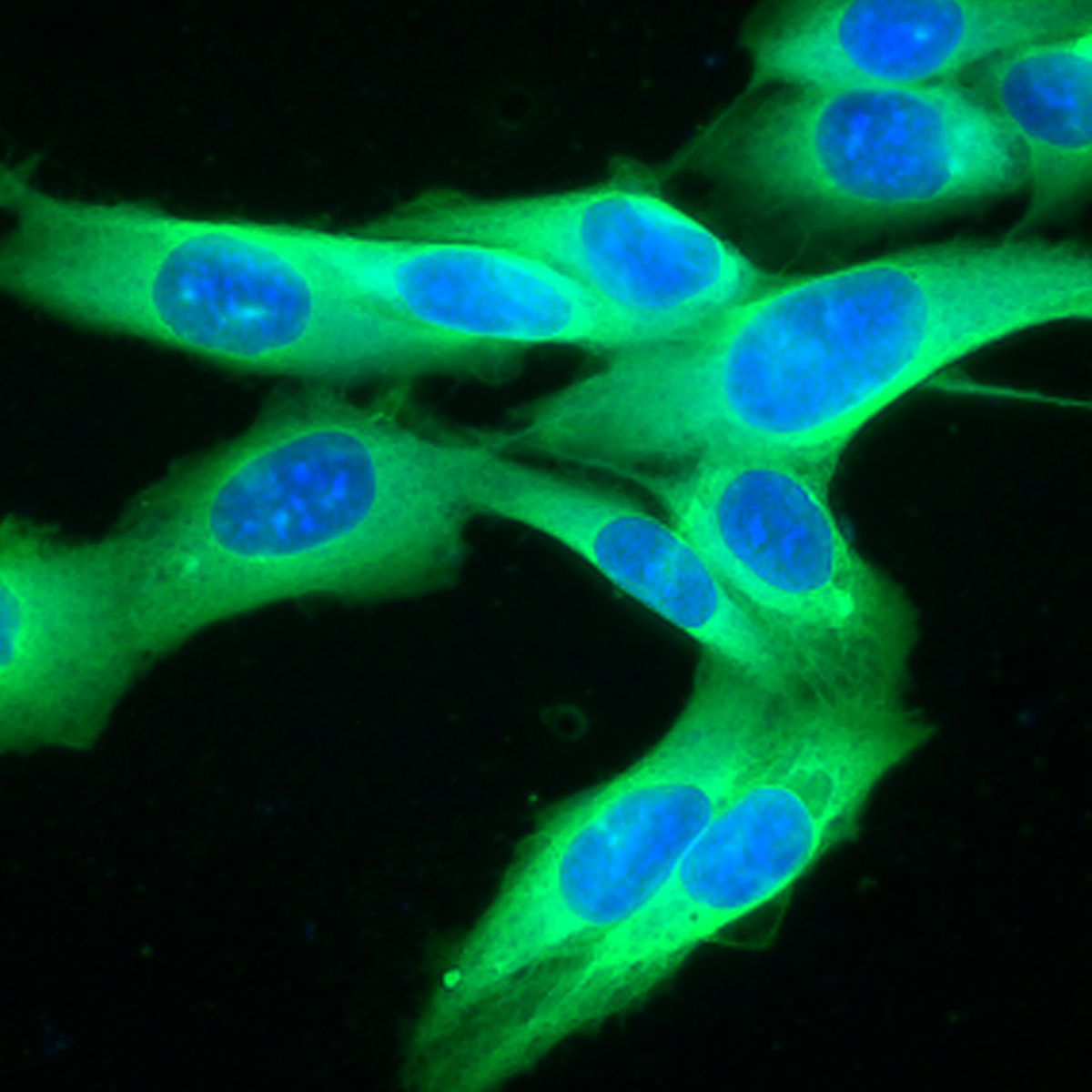 PVSRIPO Shows Promising Antitumor Activity in Refractory Melanoma