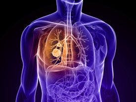 Lung Cancer Tumor