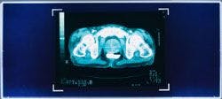 Prostate Cancer MRI Scan