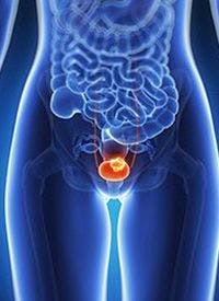 Urothelial Cancer