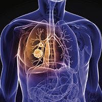 Managing Lung Cancer Patients Through the COVID-19 Crisis: What to Know