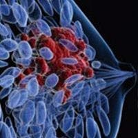 Enobosarm Shows Clinical Benefit in AR+, ER+ Metastatic Breast Cancer 