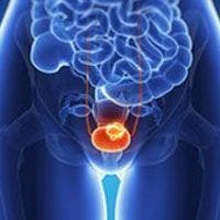 Rapid Progress Made With Late-Line Therapies in Metastatic Urothelial Cancer 