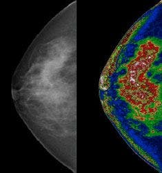 Mammogram images before and after MED-SEG processing