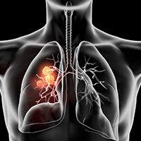 Alectinib Fails to Improve OS in ALK-Positive NSCLC