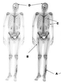 18F-fluoride positron
emission tomography (PET) bone scans