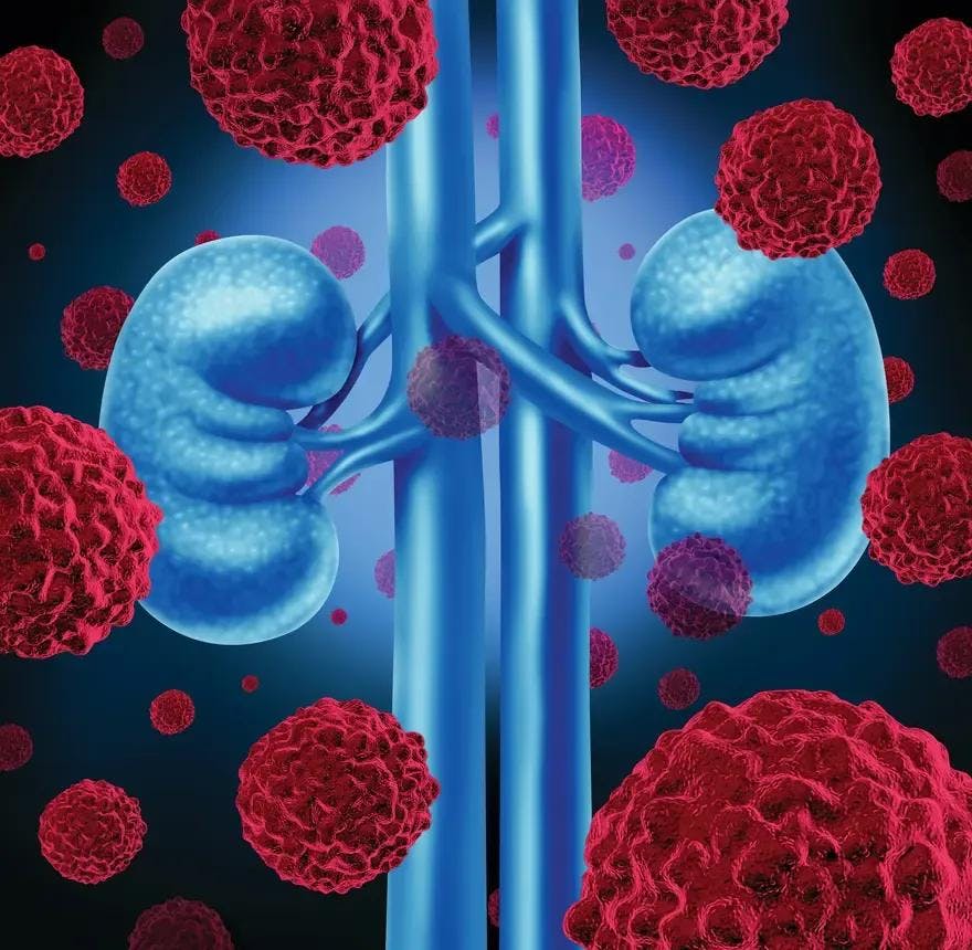 Niraparib Plus Cabozantinib Shows Early Promise in Advanced Urothelial and Kidney Cancer