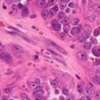 Selinexor Significantly Improves PFS in Unresectable Dedifferentiated Liposarcoma 