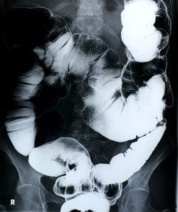 Scan of Colorectal Region