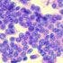 Lenvatinib Extends PFS in Differentiated Thyroid Cancer