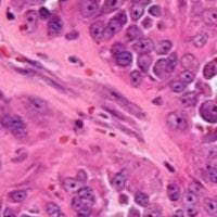 High-Grade Surface Osteosarcoma Exhibits Poor Oncologic Outcomes