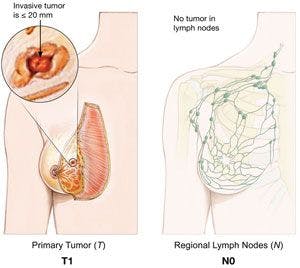 lymph nodes and breast cancer