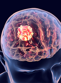 FG001 Meets Detection End Point in High-Grade Glioma
