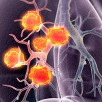 Sintilimab Combo Extends PFS in Previously Treated EGFR-Mutated NSCLC