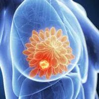 Early Stage Breast Cancer Virtual Roundtable Discussion - Scientific Interchange