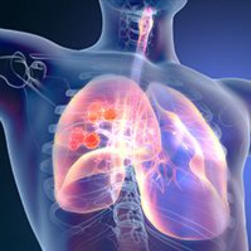 Frontline Tislelizumab/Chemo Approved in China for Advanced Squamous NSCLC