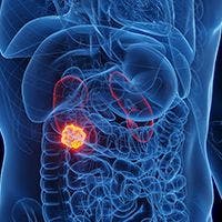 Frontline Immunotherapy, Delayed Nephrectomy May Allow for Improved Disease Control in mRCC