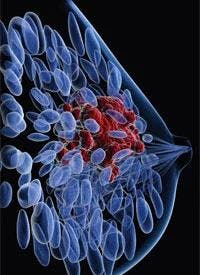 Abemaciclib Significantly Improves iDFS in High-Risk HR+ Early Breast Cancer