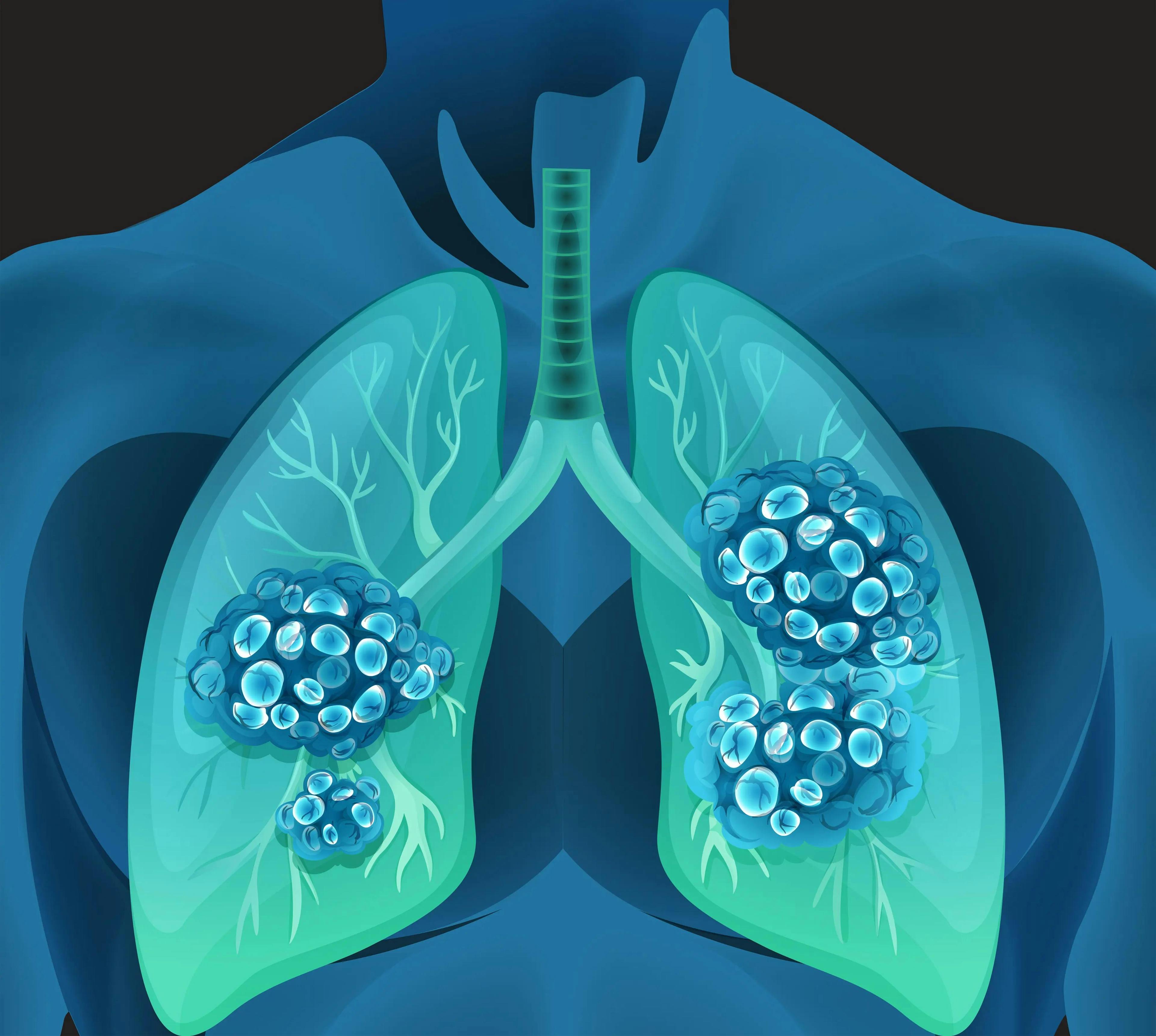 Lung Cancer- stock.adobe.com