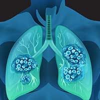 Lung cancer: © - stock.adobe.com