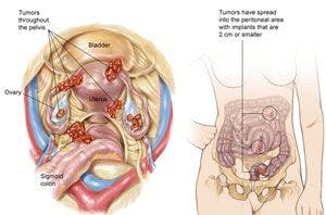 Stage IIIB Ovarian Cancer