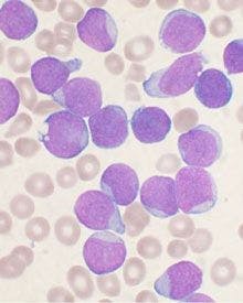 Acute lymphoblastic leukemia (ALL)